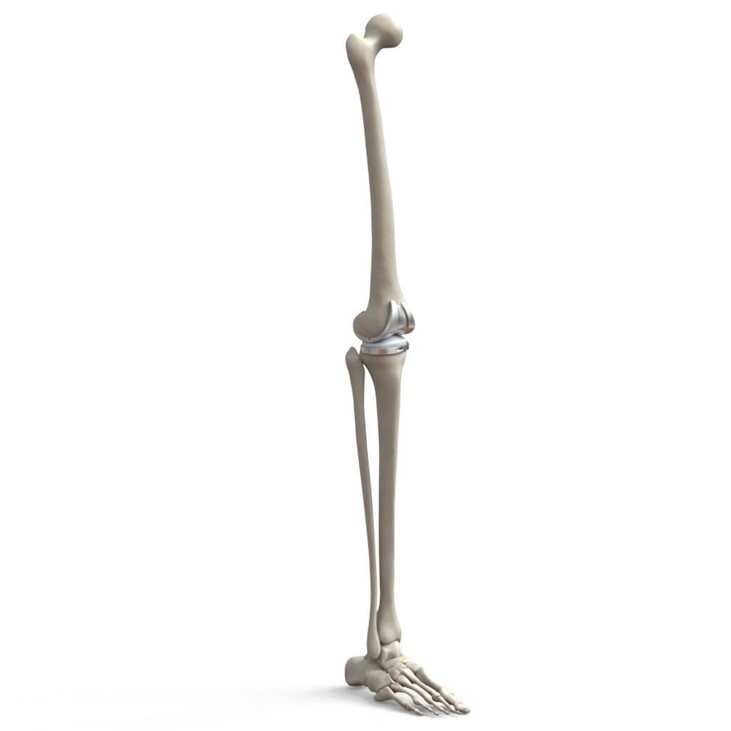 Knee Replacement Implant 3D model_3