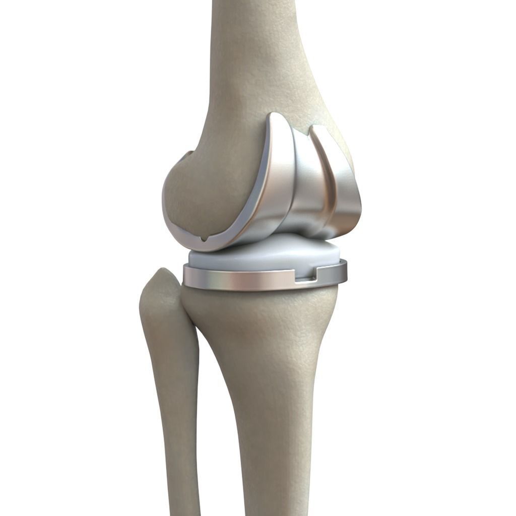 Knee Replacement Implant 3D model_1
