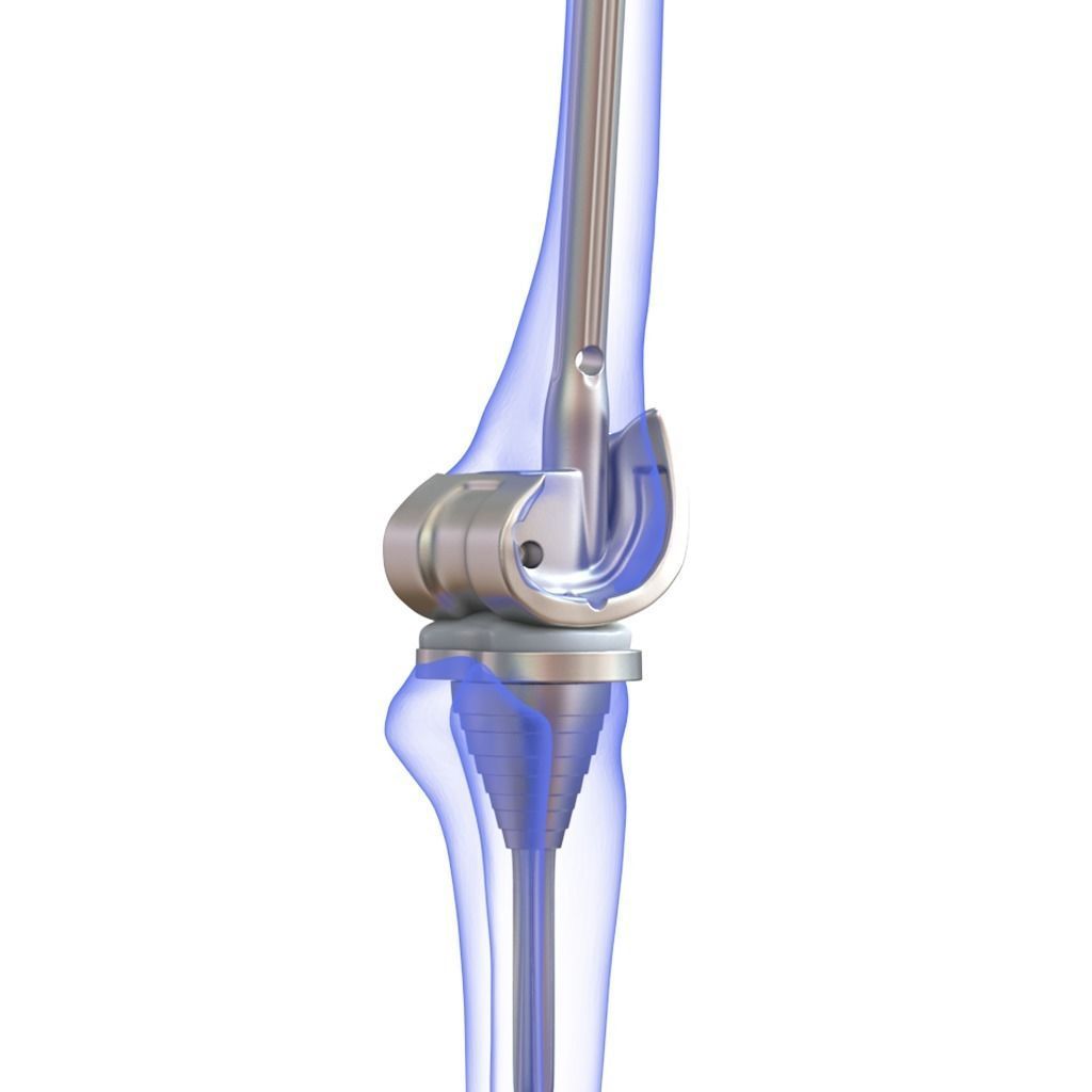 Knee Replacement Implant 3D model_5