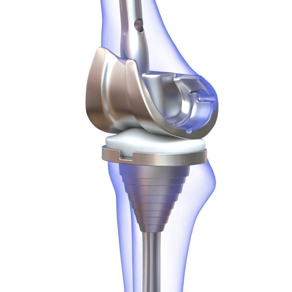 Knee Replacement Implant 3D model_7