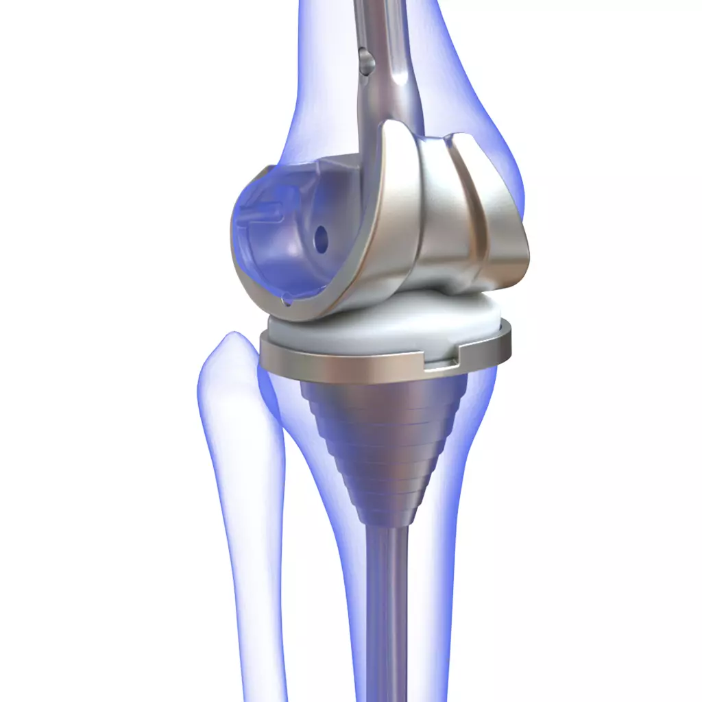 Knee Replacement Implant 3D model_0