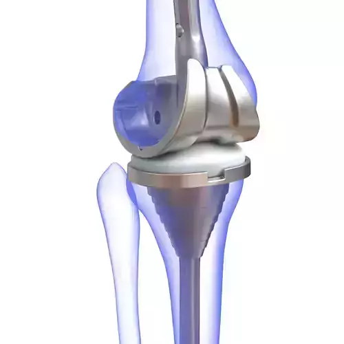 Knee Replacement Implant 3D model