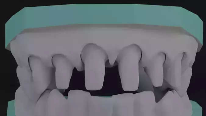 Human teeth restoration 3D print model