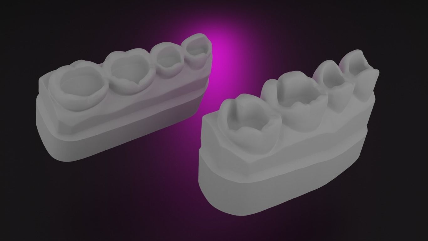 Guidline in composite filling 3D print model_2