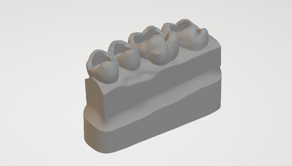 Guidline in composite filling 3D print model_4