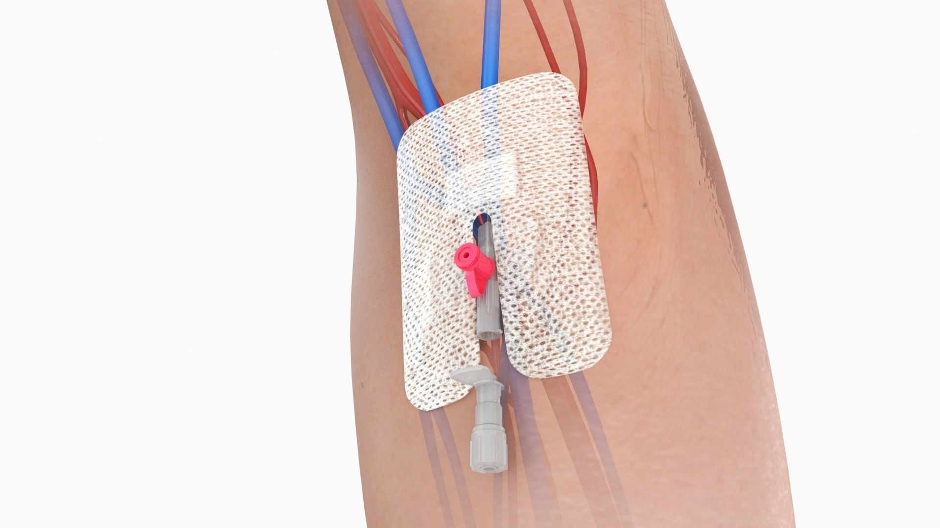 Injected Cannula with sticking plaster Low-poly 3D model_1