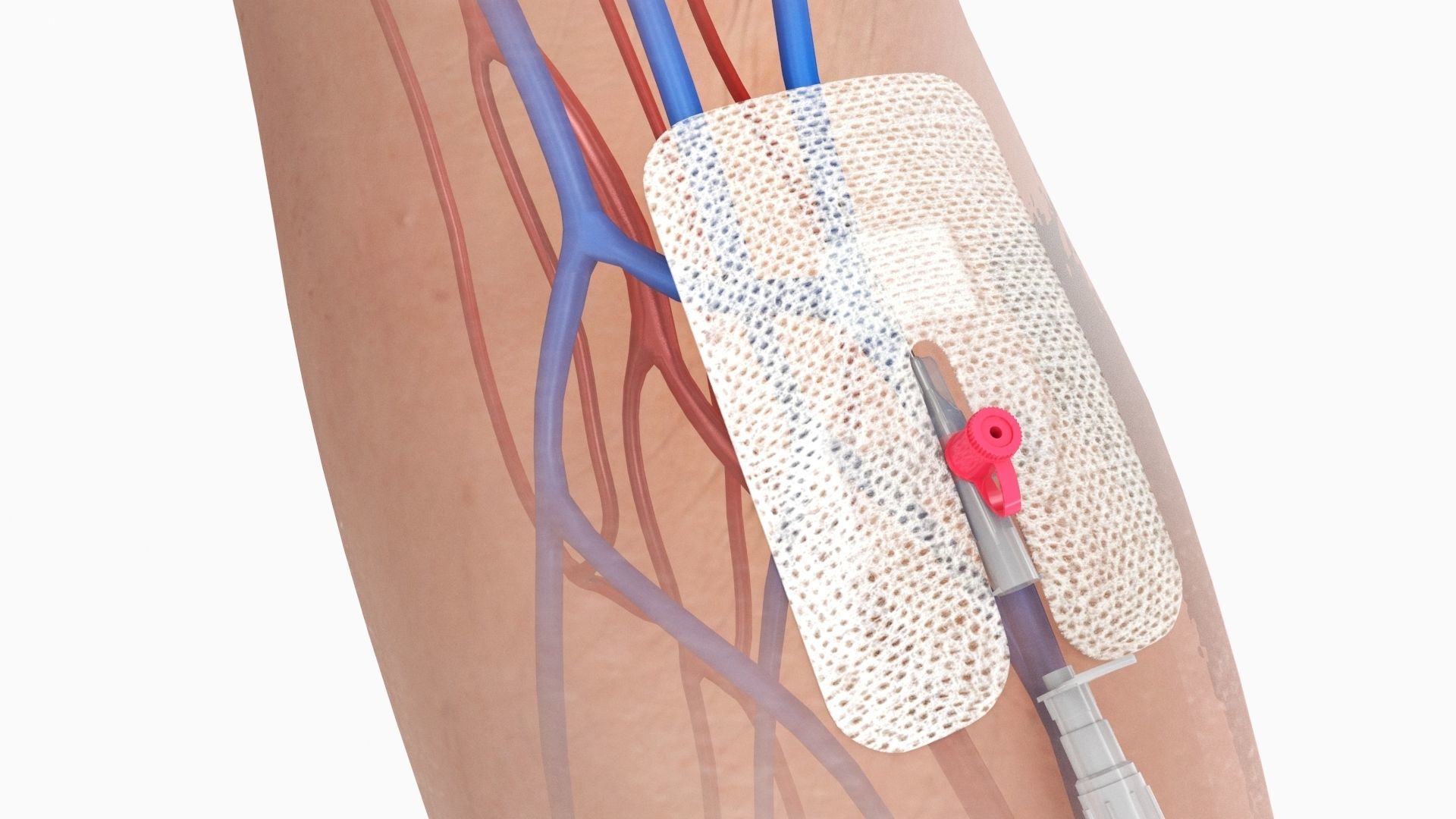 Injected Cannula with sticking plaster Low-poly 3D model_2