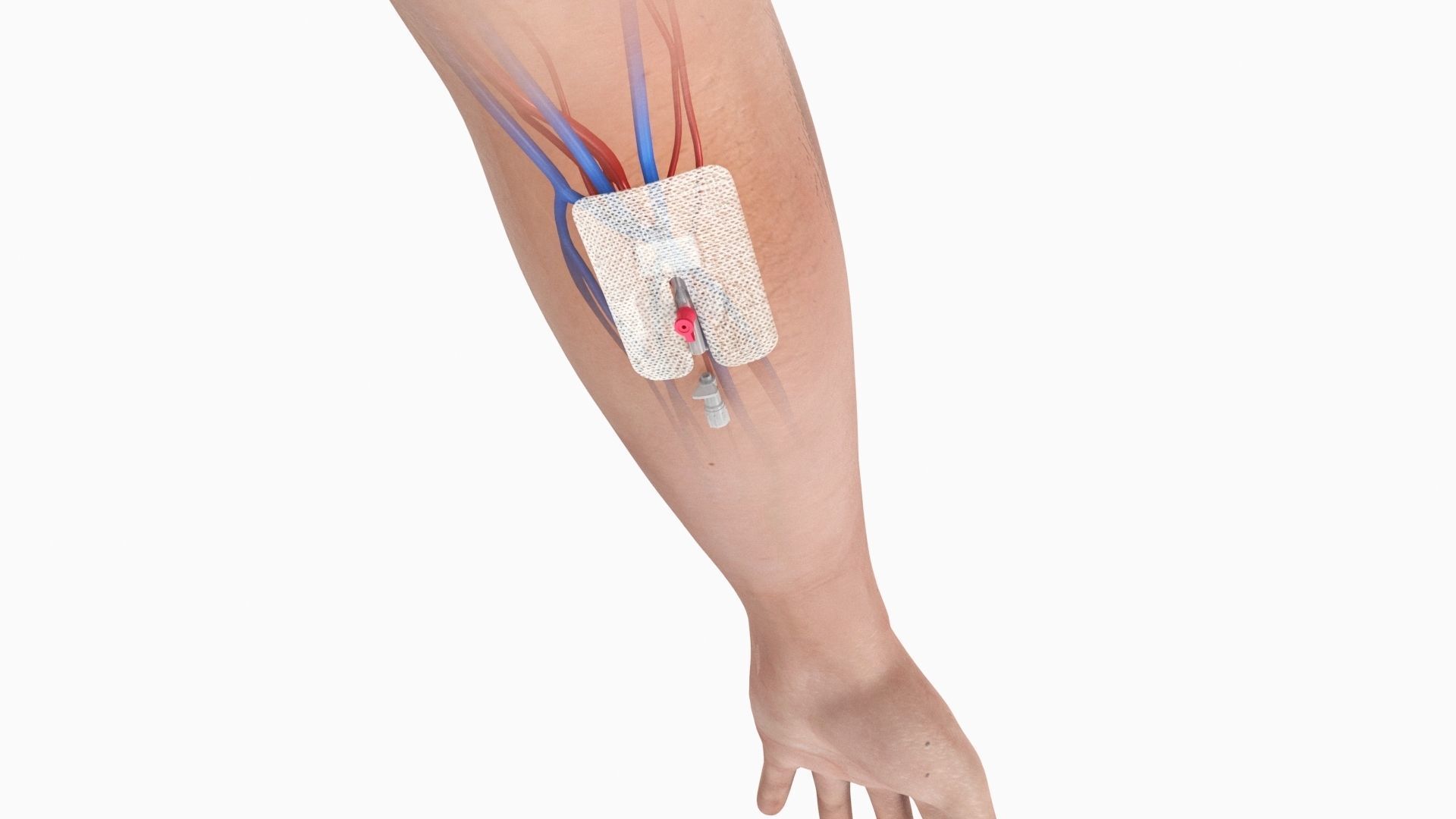 Injected Cannula with sticking plaster Low-poly 3D model_6