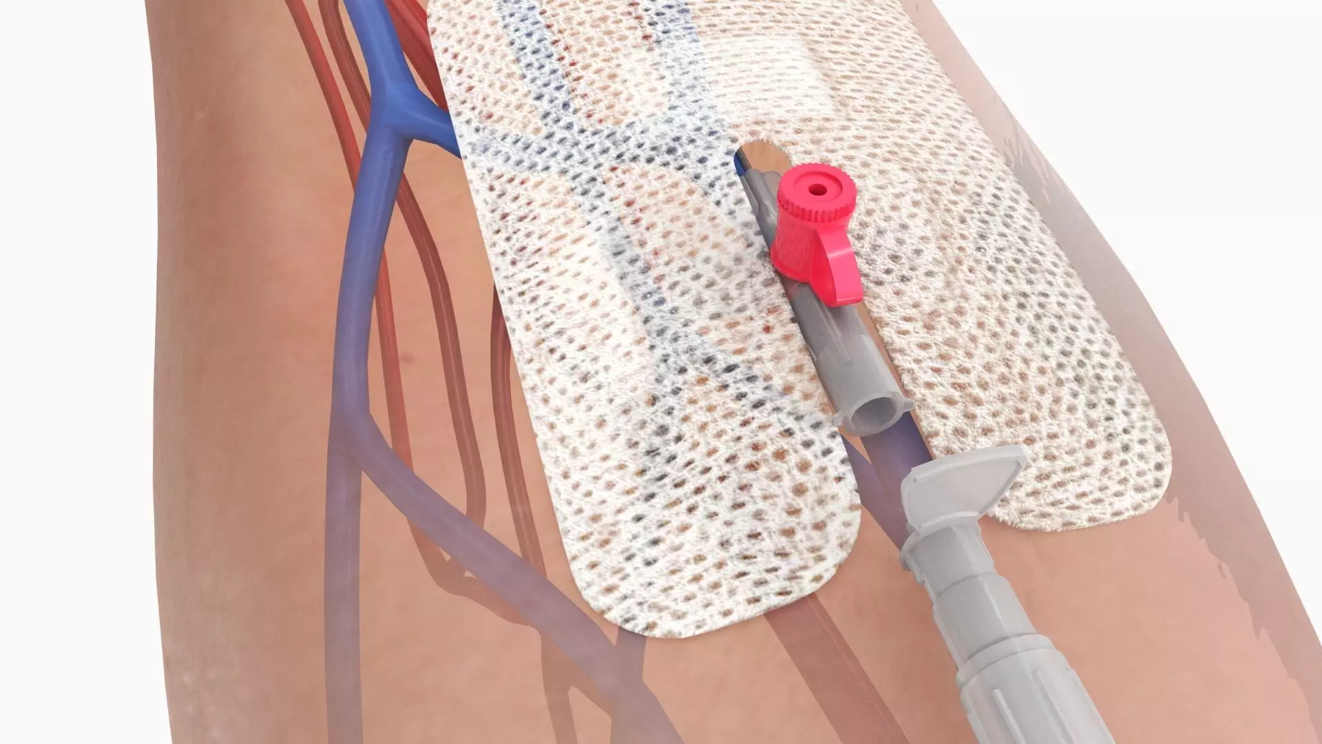 Injected Cannula with sticking plaster Low-poly 3D model_0