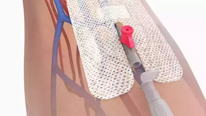 Injected Cannula with sticking plaster Low-poly 3D model