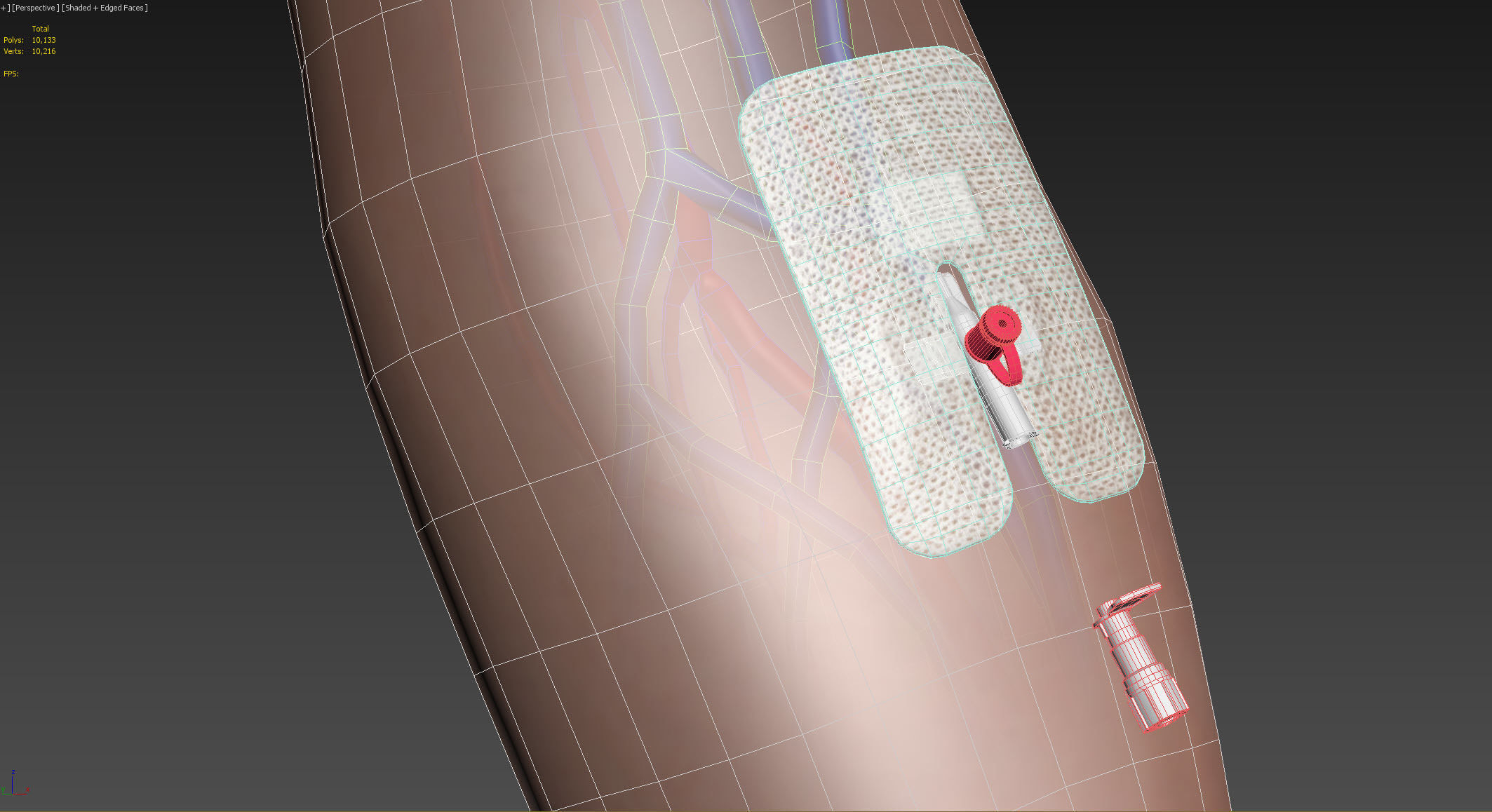 Injected Cannula with sticking plaster Low-poly 3D model_19