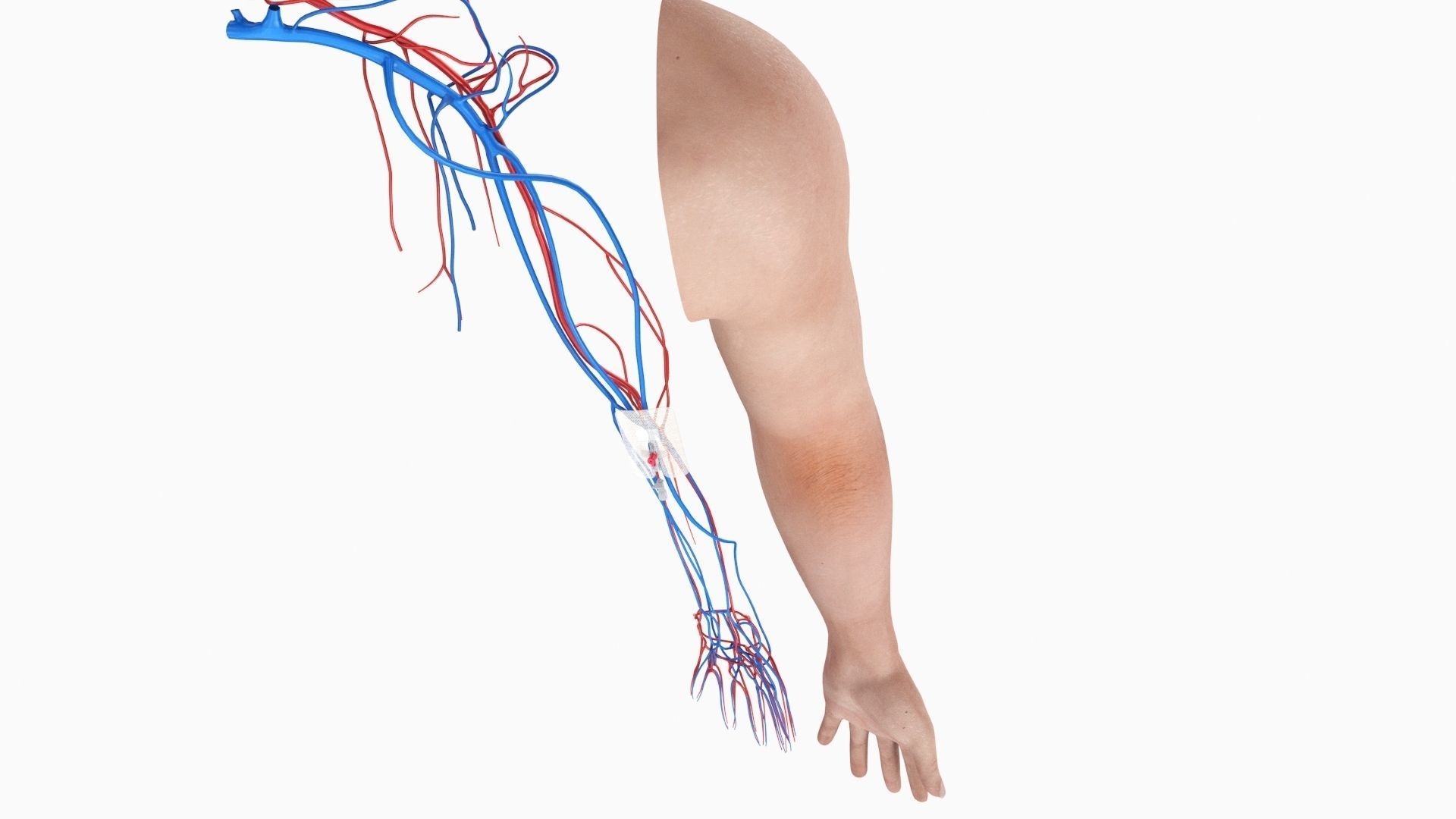 Injected Cannula with sticking plaster Low-poly 3D model_8