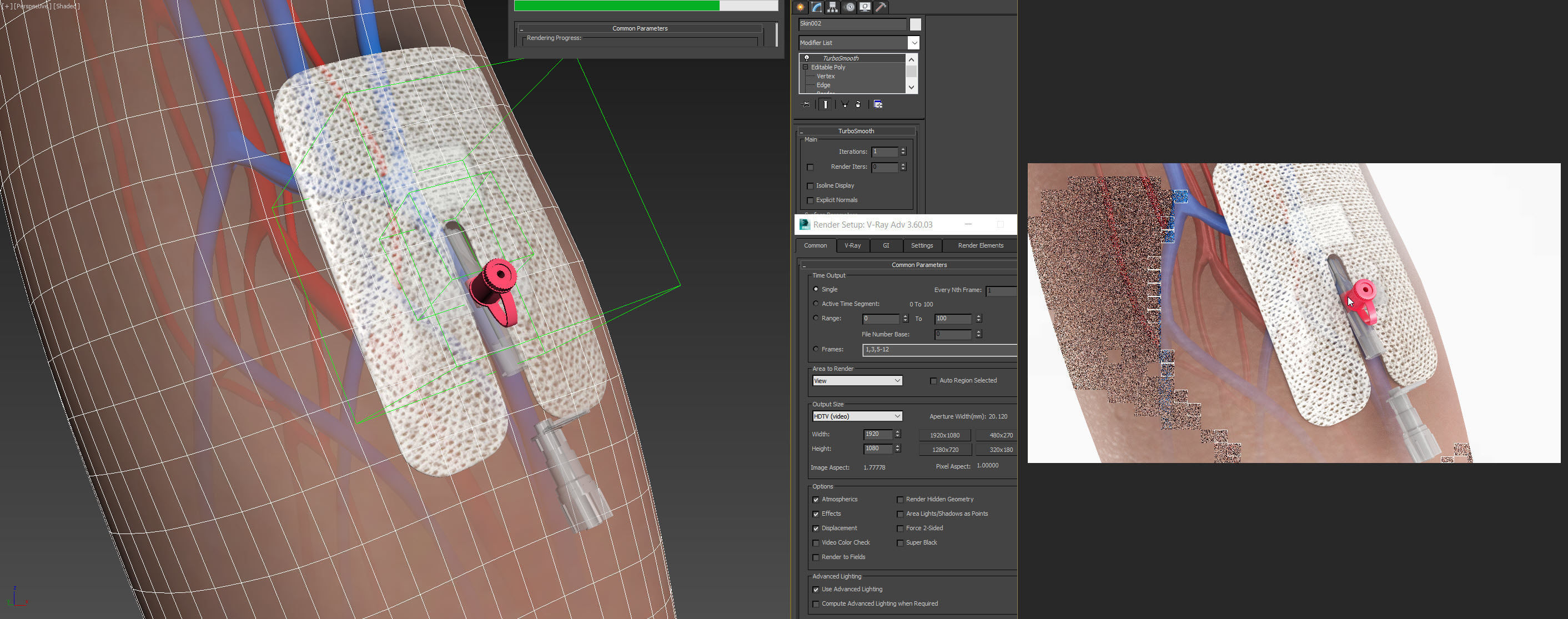 Injected Cannula with sticking plaster Low-poly 3D model_20