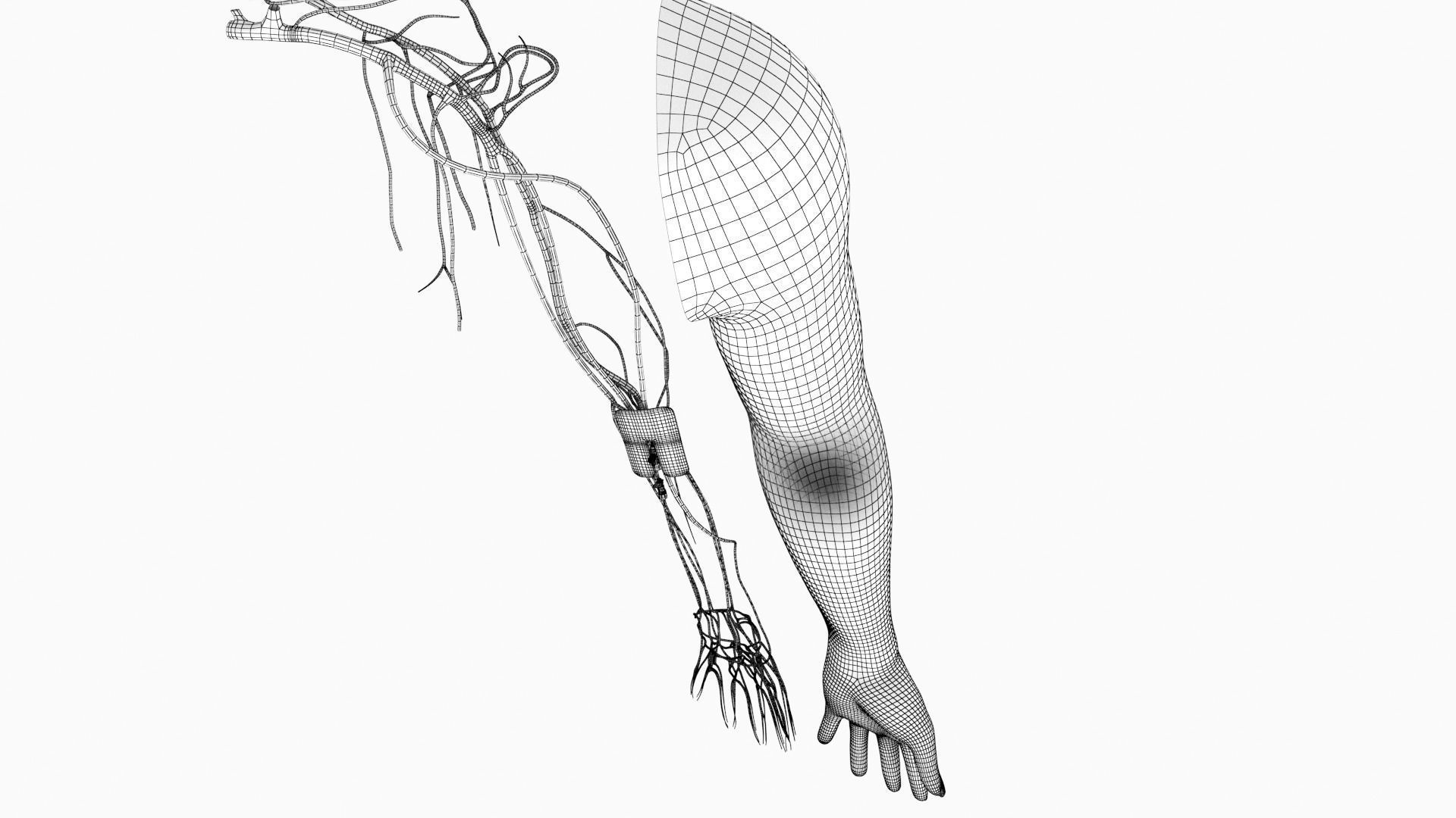 Injected Cannula with sticking plaster Low-poly 3D model_10