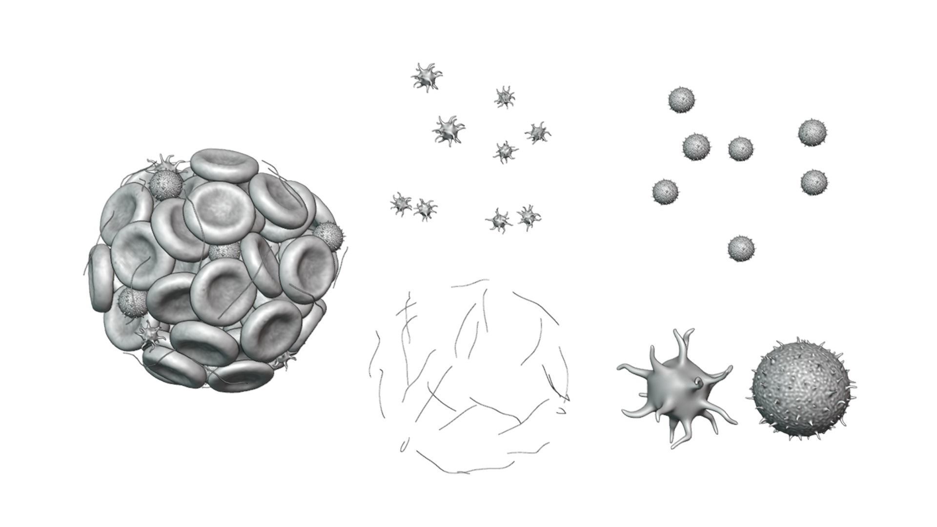 Blood Clot Thrombus 3D model_2