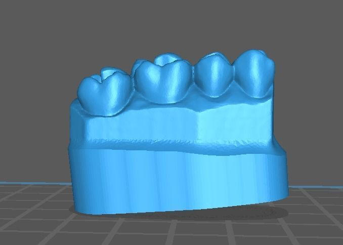 teeth models for restoration class 1 3D print model_1