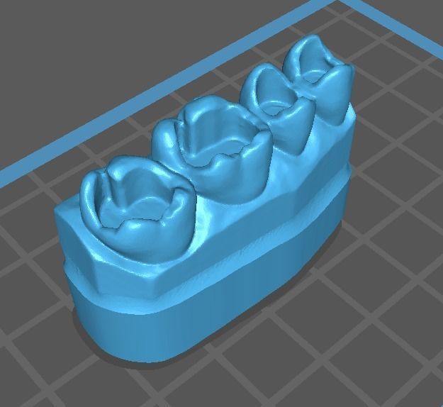 teeth models for restoration class 1 3D print model_2