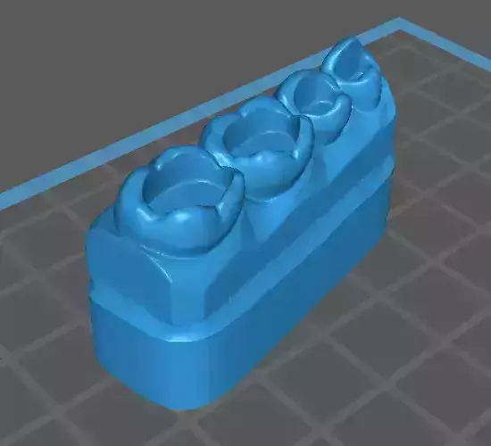 teeth model for restoration class 1 3D print model