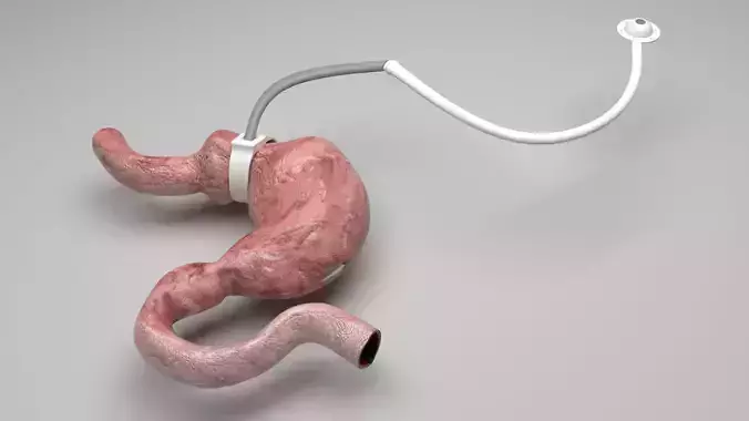 Stomach With Stomach Band 3D model