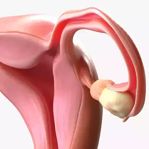 Female Reproductive System Cyst