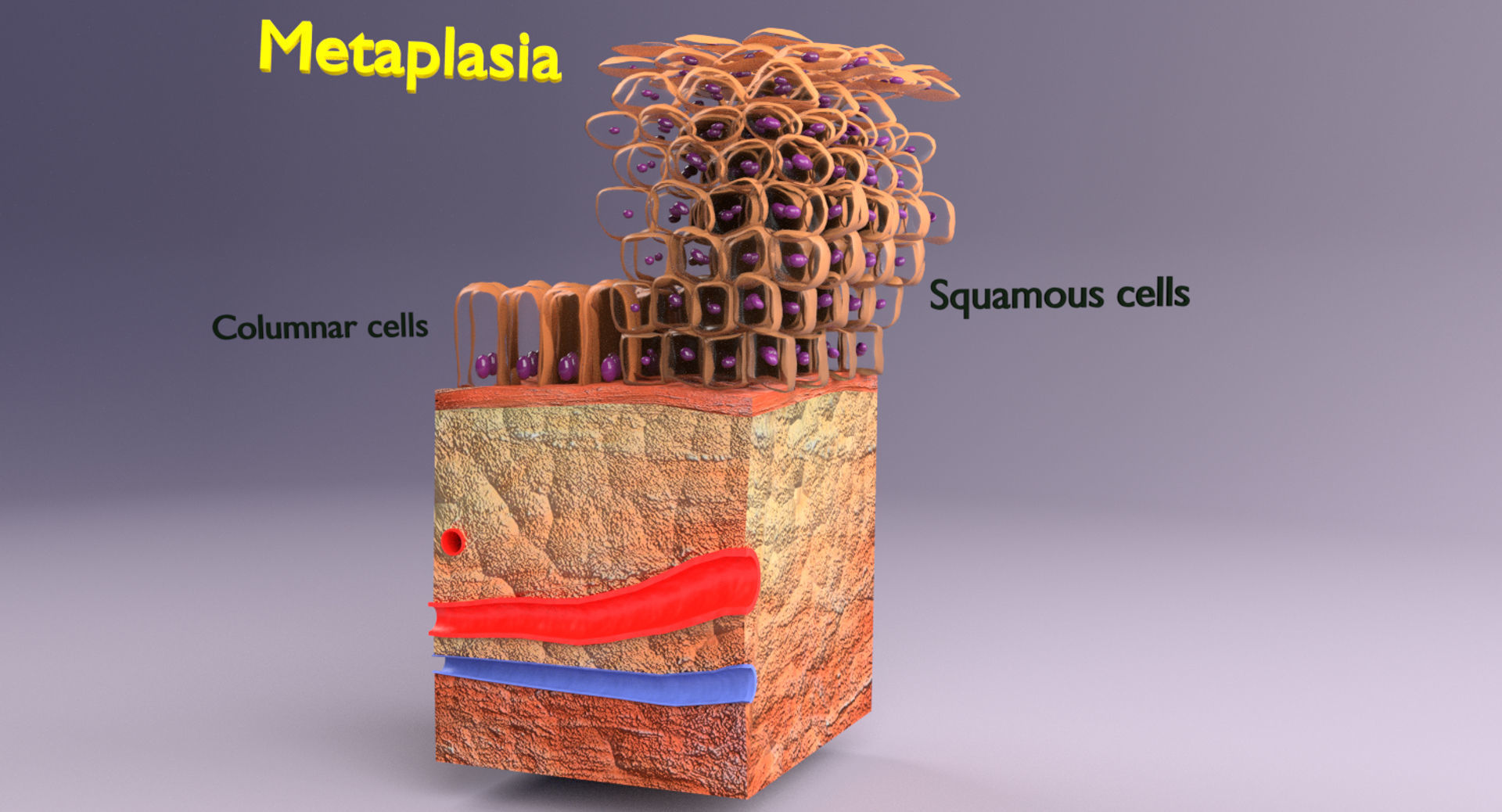 adaptation epithelial cell changes normal to cancer Low-poly 3D model_11
