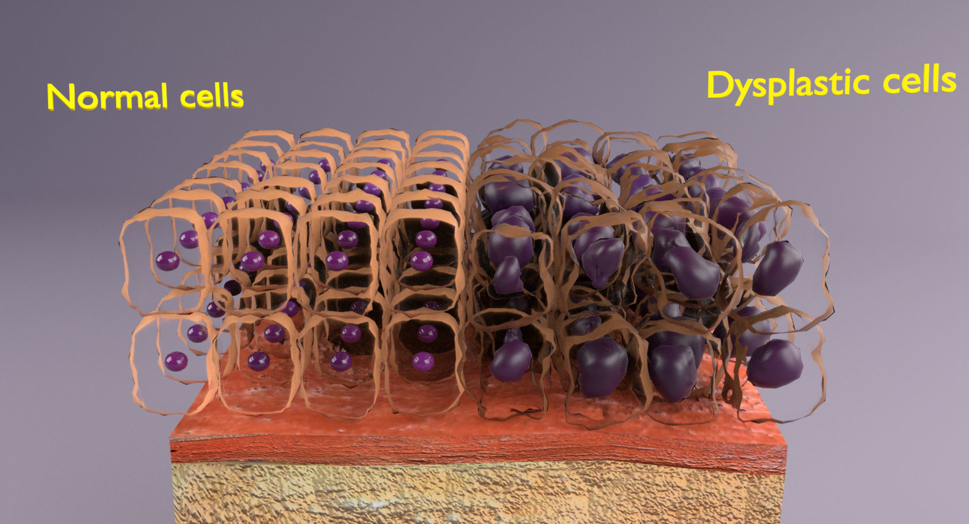 adaptation epithelial cell changes normal to cancer Low-poly 3D model_20