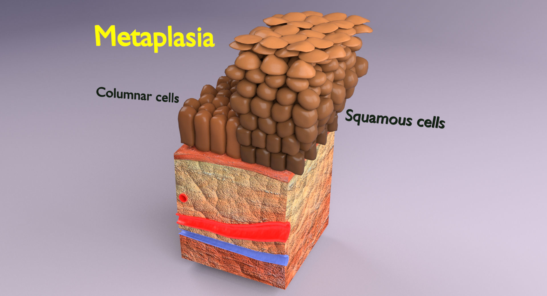 adaptation epithelial cell changes normal to cancer Low-poly 3D model_10