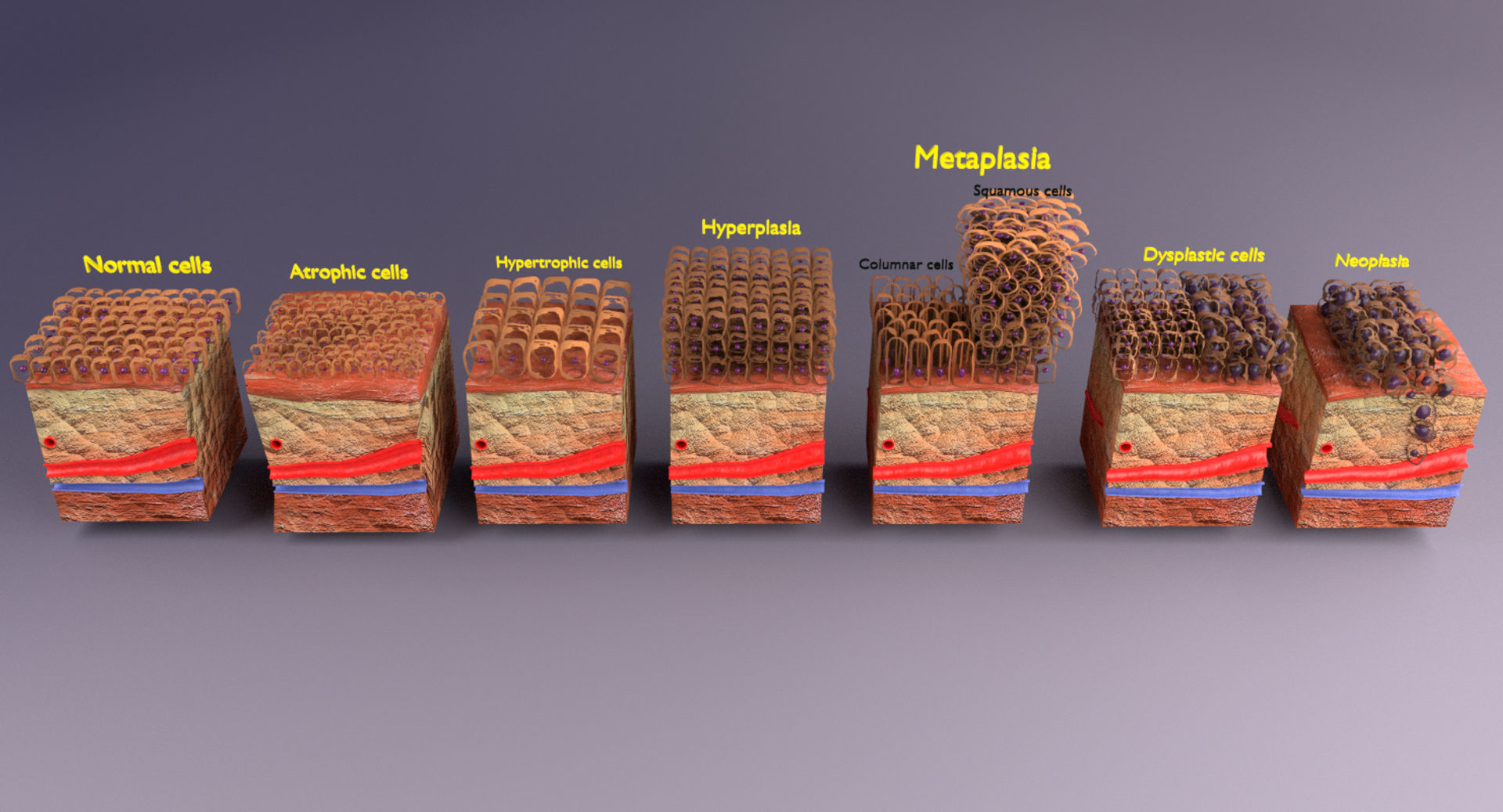adaptation epithelial cell changes normal to cancer Low-poly 3D model_22