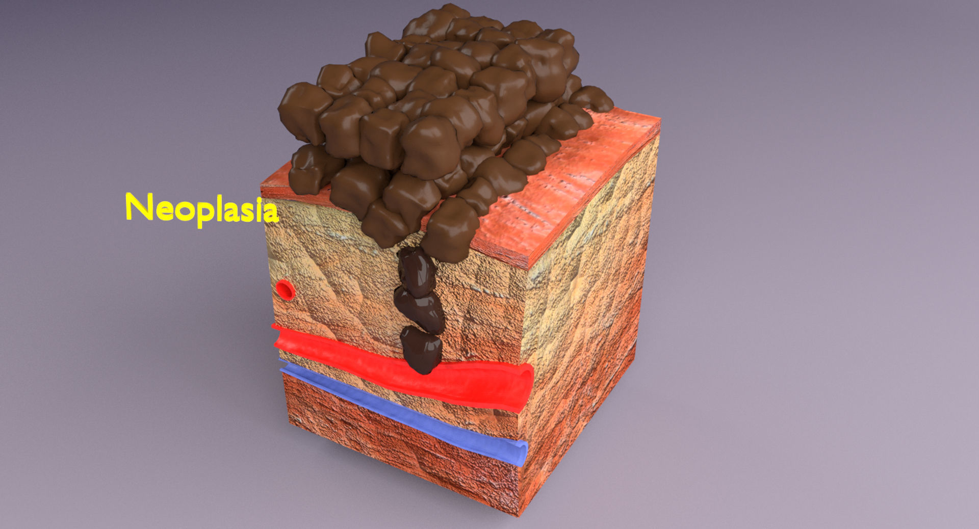 adaptation epithelial cell changes normal to cancer Low-poly 3D model_4