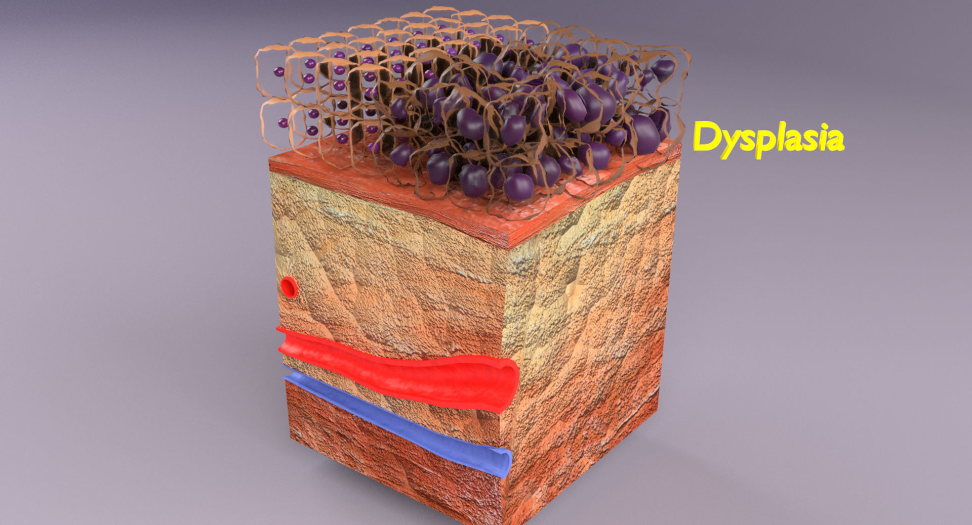 adaptation epithelial cell changes normal to cancer Low-poly 3D model_18