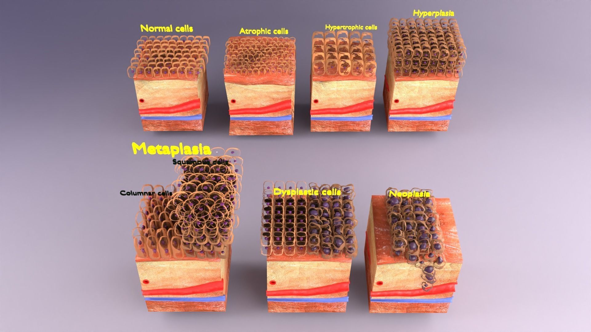 adaptation epithelial cell changes normal to cancer Low-poly 3D model_3