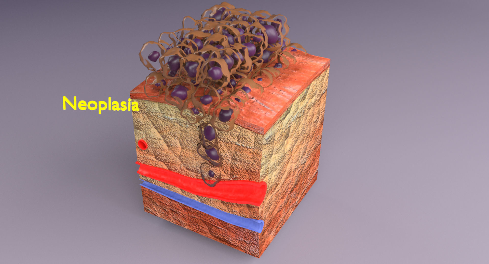 adaptation epithelial cell changes normal to cancer Low-poly 3D model_14