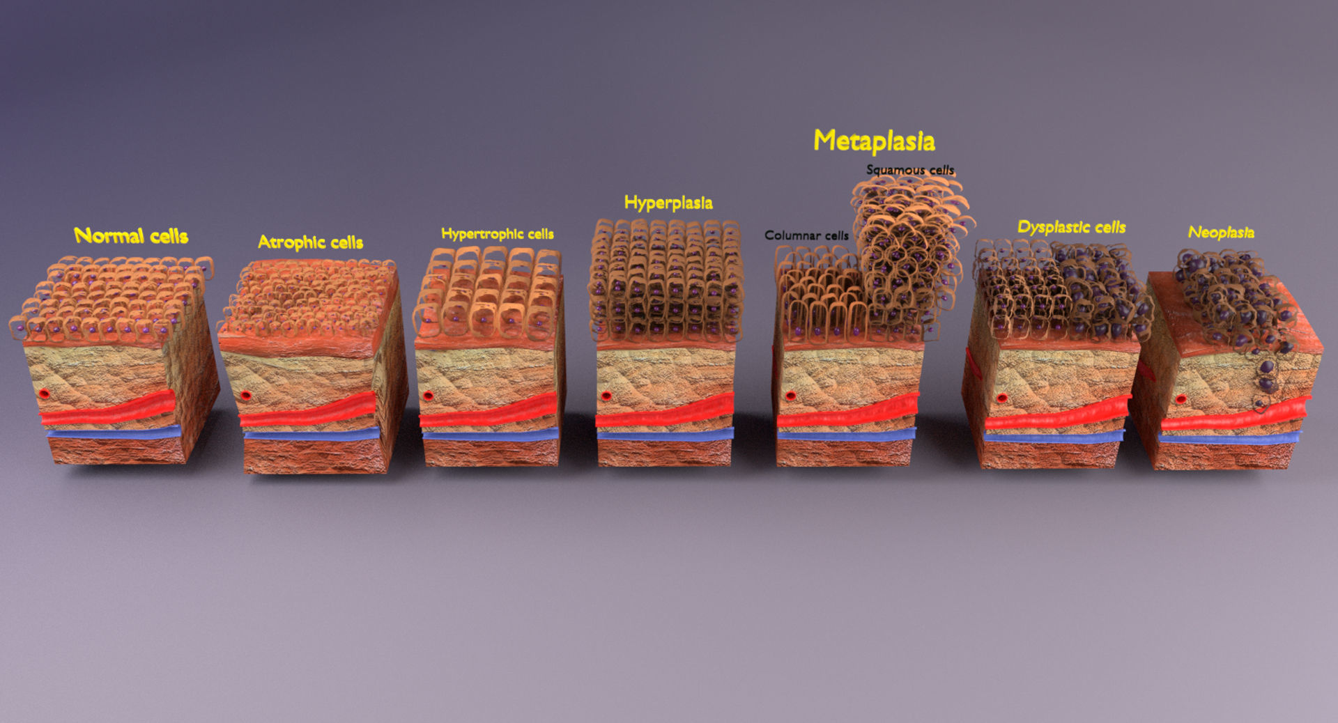 adaptation epithelial cell changes normal to cancer Low-poly 3D model_19