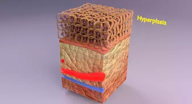 adaptation epithelial cell changes normal to cancer Low-poly 3D model