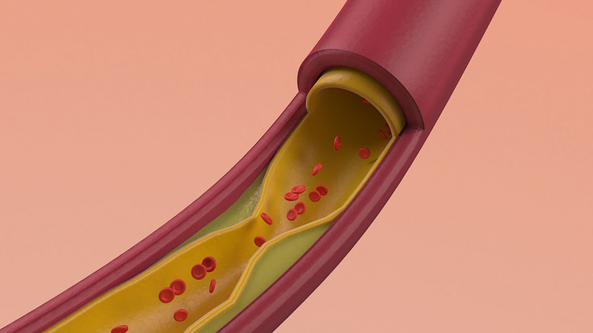 Artery Vein Clog Clot Clogged Stream Bloodflow Layers Section 3D model CGTrader