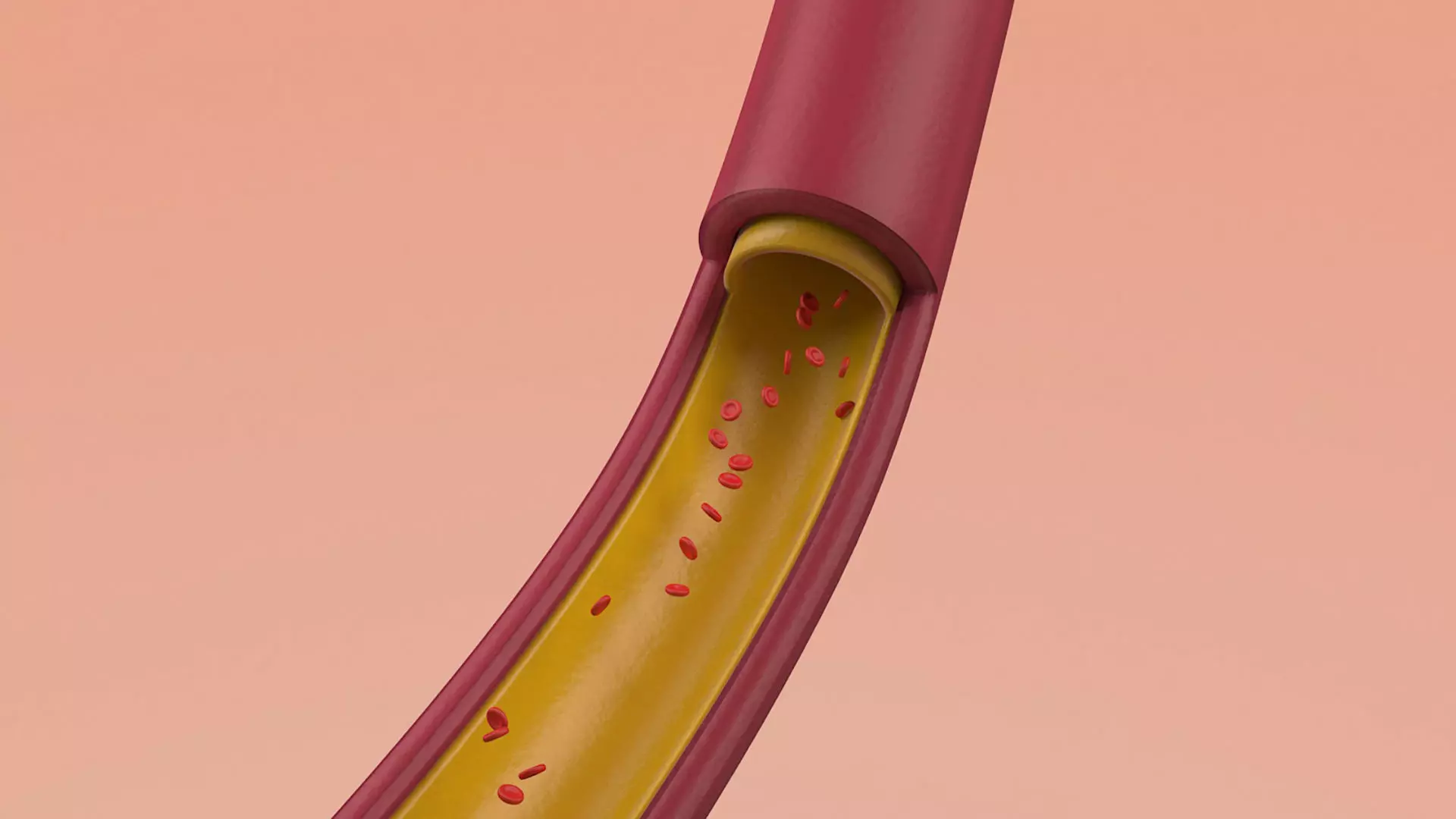 Artery Vein Clog Clot Clogged Stream Bloodflow Layers Section 3D model