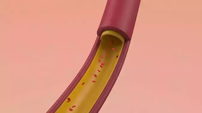 Artery Vein Clog Clot Clogged Stream Bloodflow Layers Section