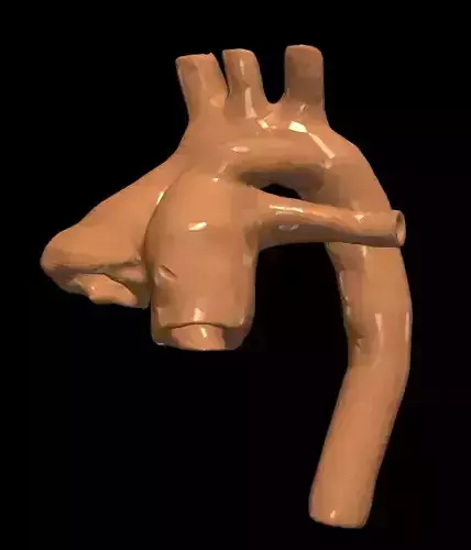 3D model of heart with transposition of the great arteries