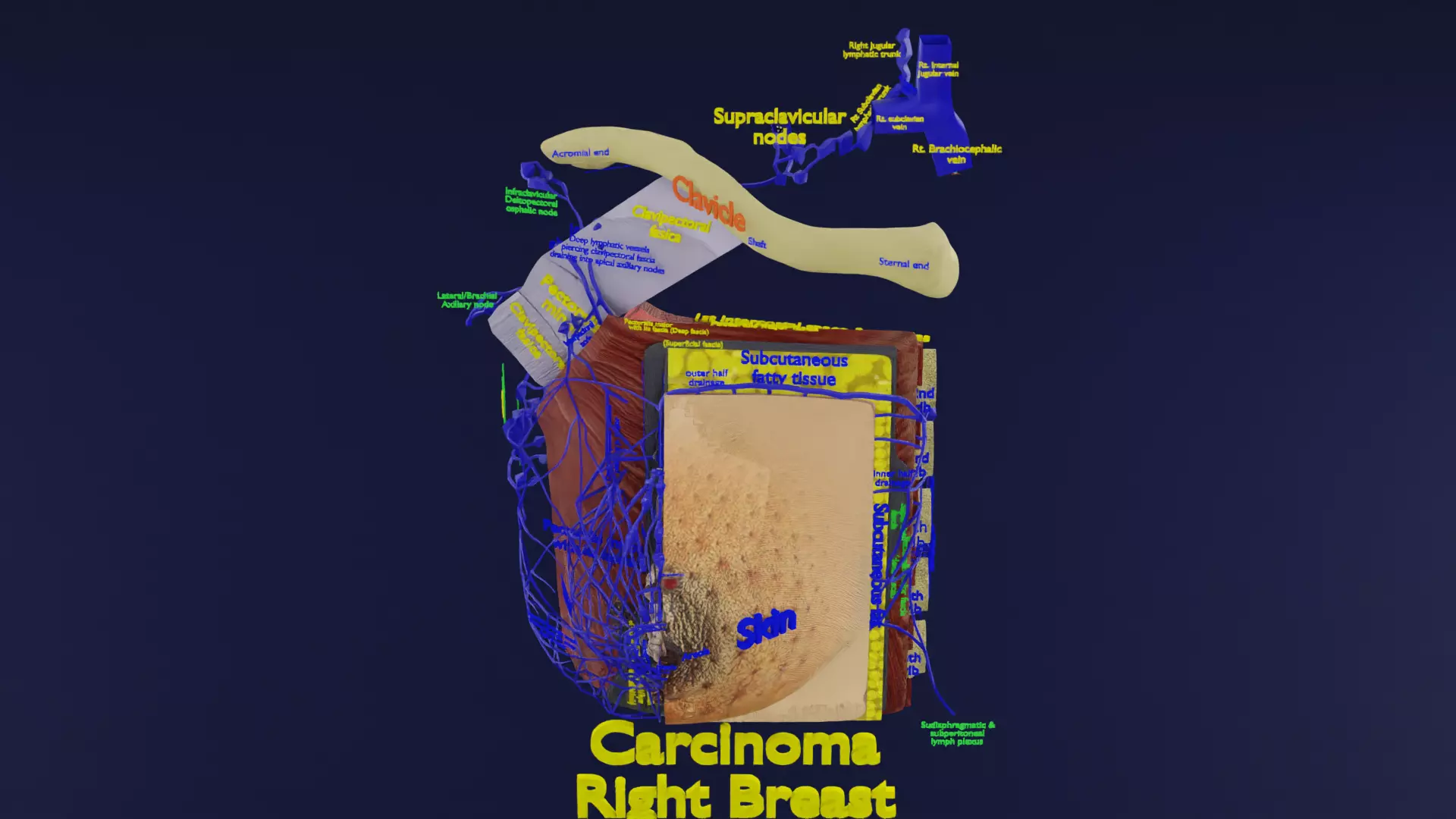 Cancer types spread labelled detail 3D model