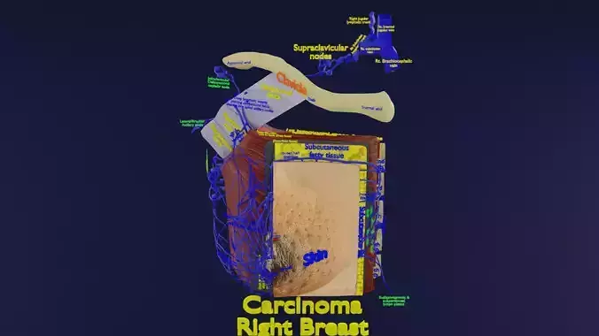 Breast Cancer types spread labelled detail 3D model
