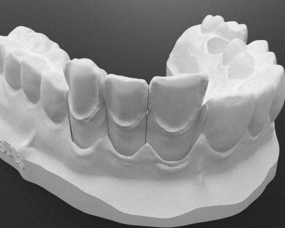 Model practices veneers 3D print model_1