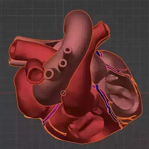 3d model of heart with atrial septal defect 