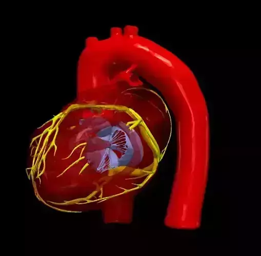 3d model of heart with tetralogy of Fallot 3D print model