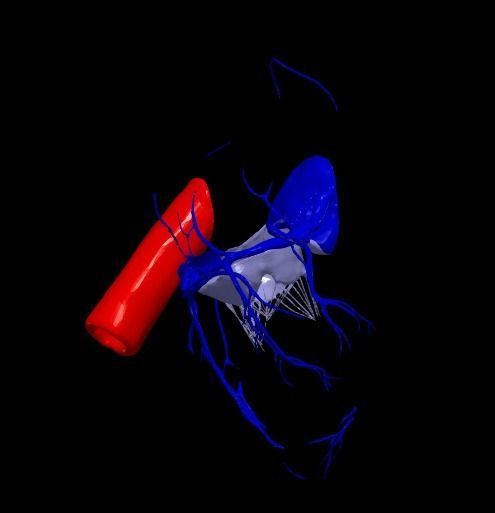 3d model of the heart with tetralogy of Fallot long axis 3D print model_5