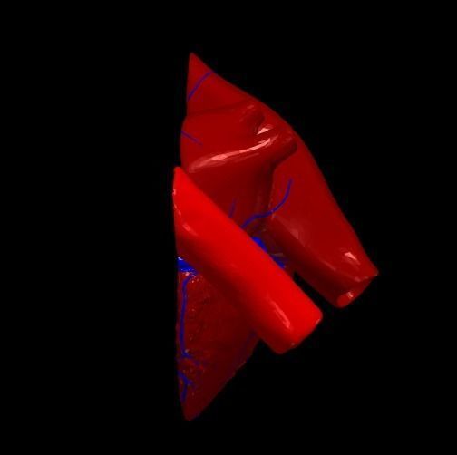 3d model of the heart with tetralogy of Fallot long axis 3D print model_2