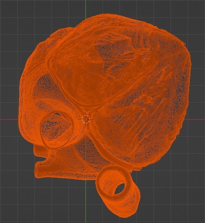3d model of the heart with tetralogy of Fallot long axis 3D print model_15