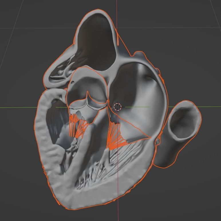 3d model of the heart with tetralogy of Fallot long axis 3D print model_16
