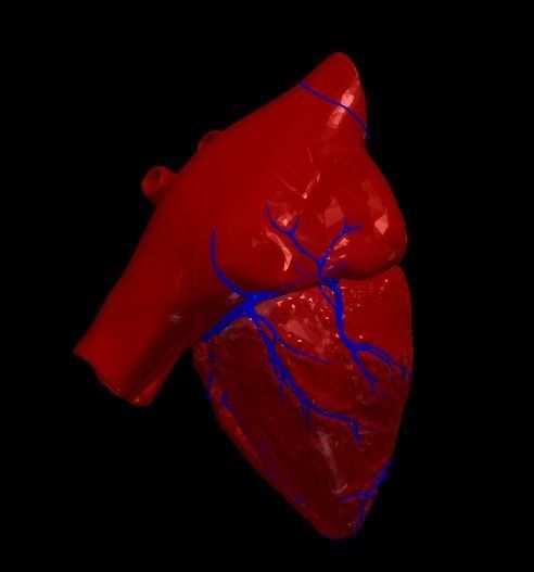 3d model of the heart with tetralogy of Fallot long axis 3D print model_4