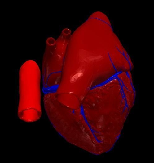3d model of the heart with tetralogy of Fallot long axis 3D print model_3