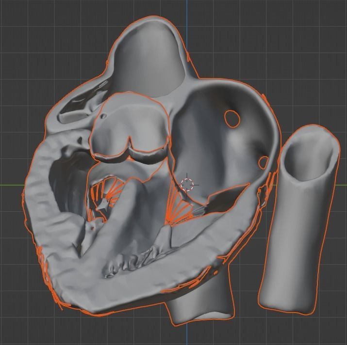 3d model of the heart with tetralogy of Fallot long axis 3D print model_10